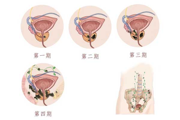 前列腺癌